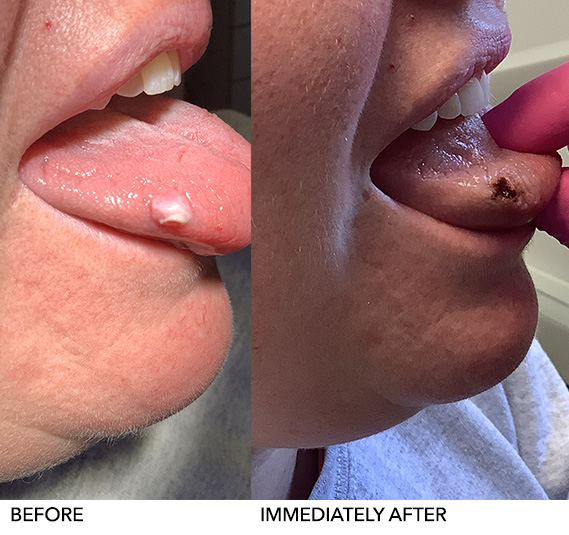 laser-treatments2